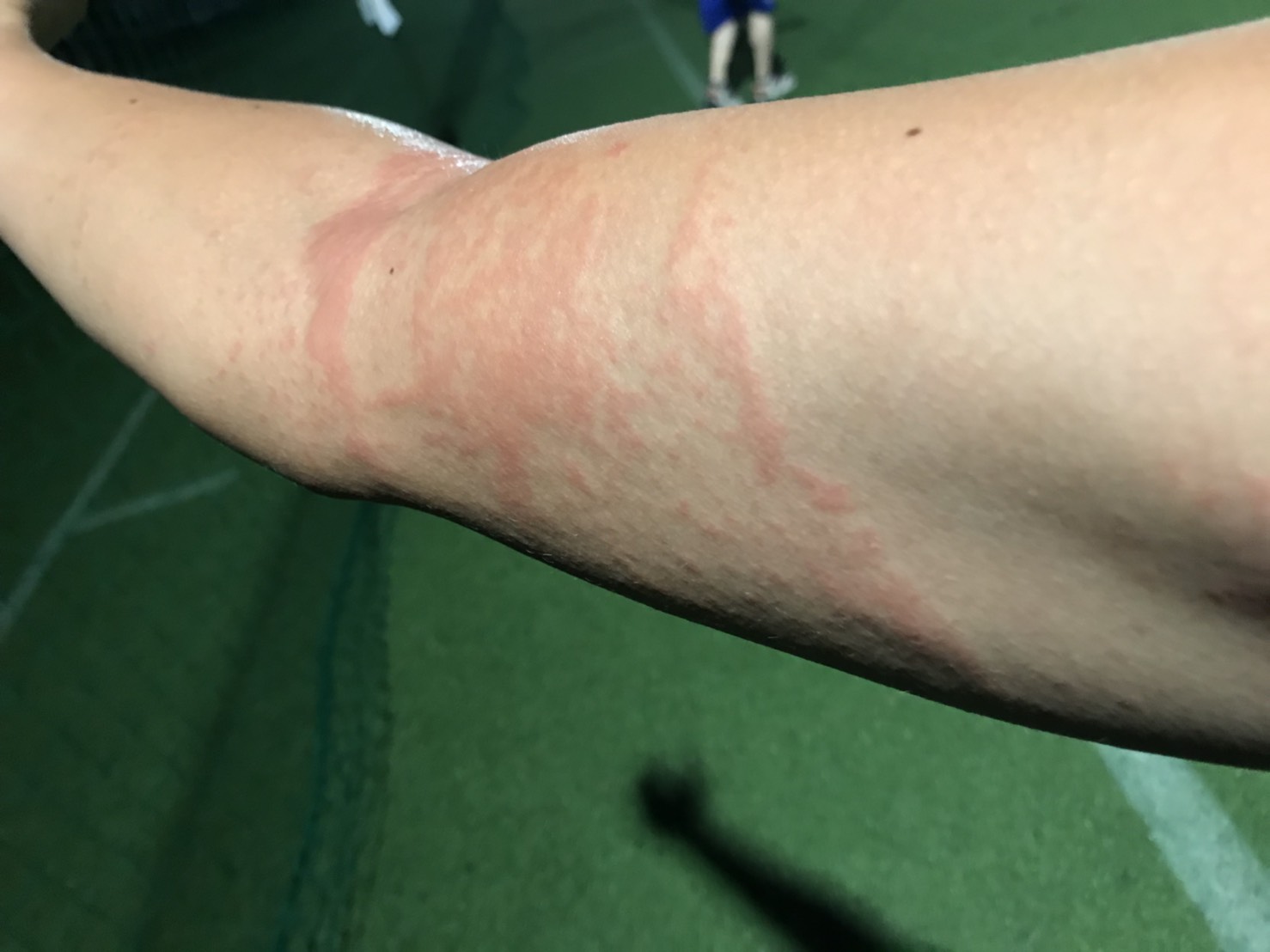 痛たたた!クラゲに刺された時の応急処置・対処方法|じゅんいっちゃんねる 痛たたた!クラゲに刺された時の応急処置・対処方法|じゅんいっちゃんねる